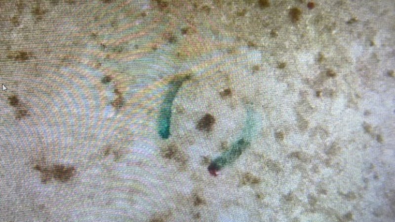 Melanoma on the skin