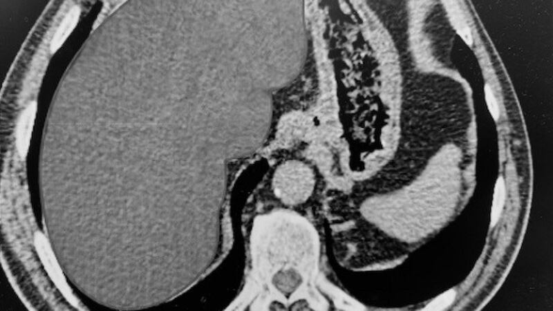 Cat Scan of liver located on left