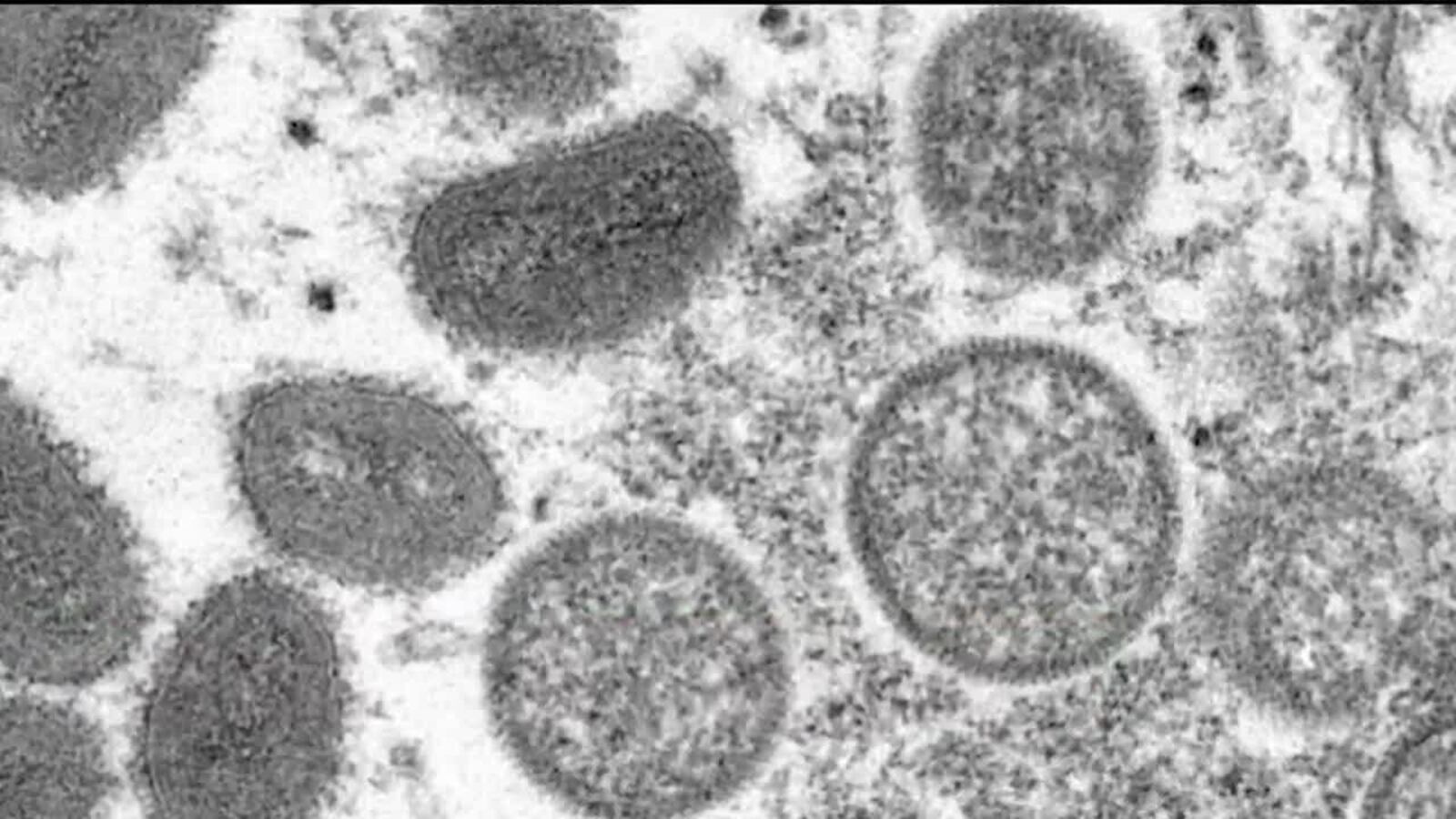 Clark County School District identifies monkeypox case at Las Vegas